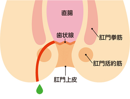 痔ろう